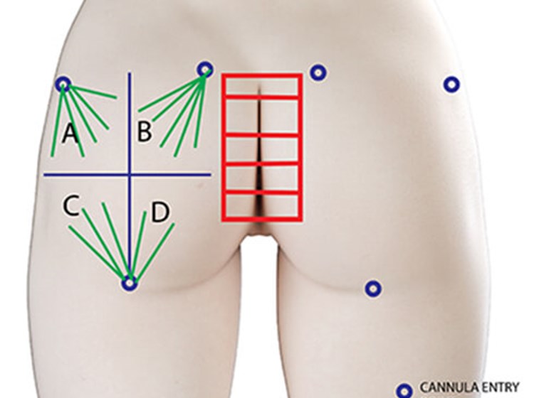HOW I DO IT - Buttock augmentation
