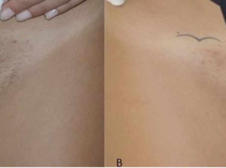 Laser And Light Based Hair Removal The Pmfa Journal