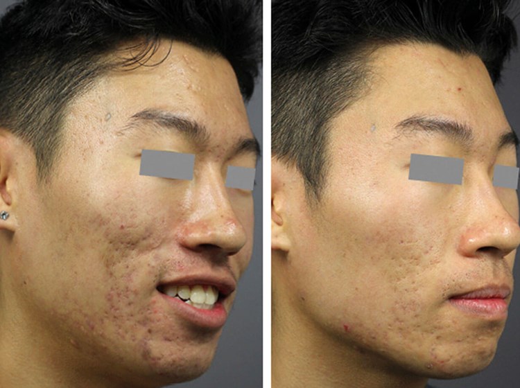 Jeg har erkendt det En del Omkreds HOW I DO IT - High-energy acne scar treatment with a fractional Q-switched  Nd:YAG laser | The PMFA Journal