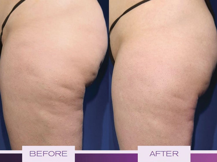 does semaglutide help with cellulite Cellulite therapy in 2022 – new treatment options making grades for the new year does semaglutide help with cellulite Cellulite therapy in 2022 – new treatment options making grades for the new year