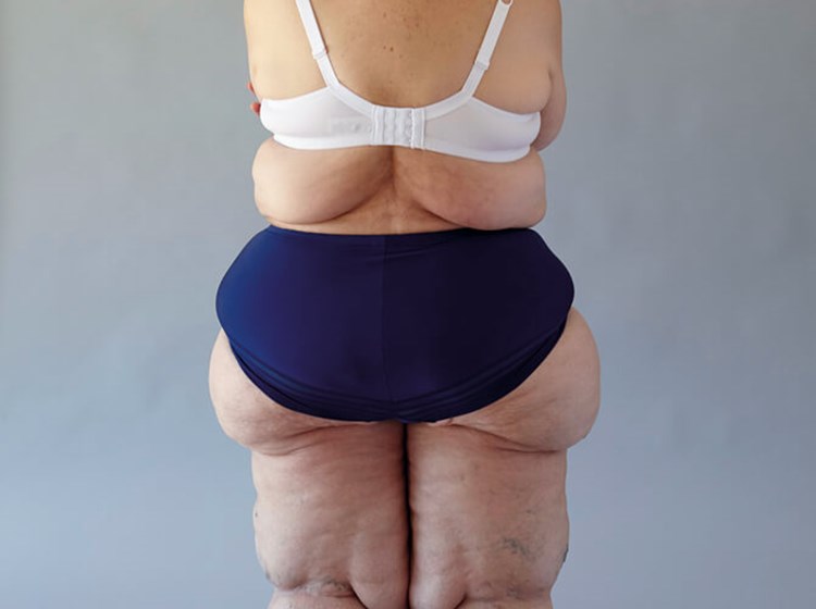 Lipoedema awareness – the current state of play