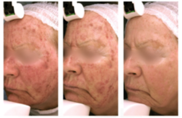 best silicone scar sheets for keloid