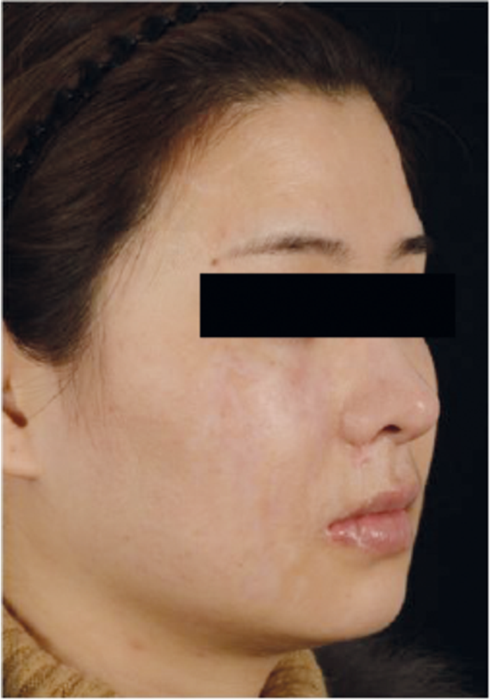 What’s new in treating hypertrophic scars and keloids? The PMFA Journal