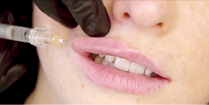 HOW I DO IT Approaches to lip augmentation: Perioral rejuvenation – a  multi-product approach | The PMFA Journal
