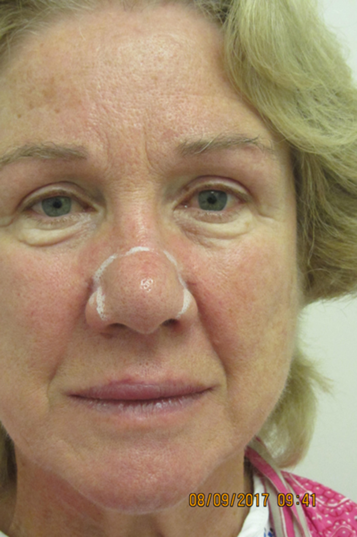 A suggested management pathway for rhinophyma and benign superficial