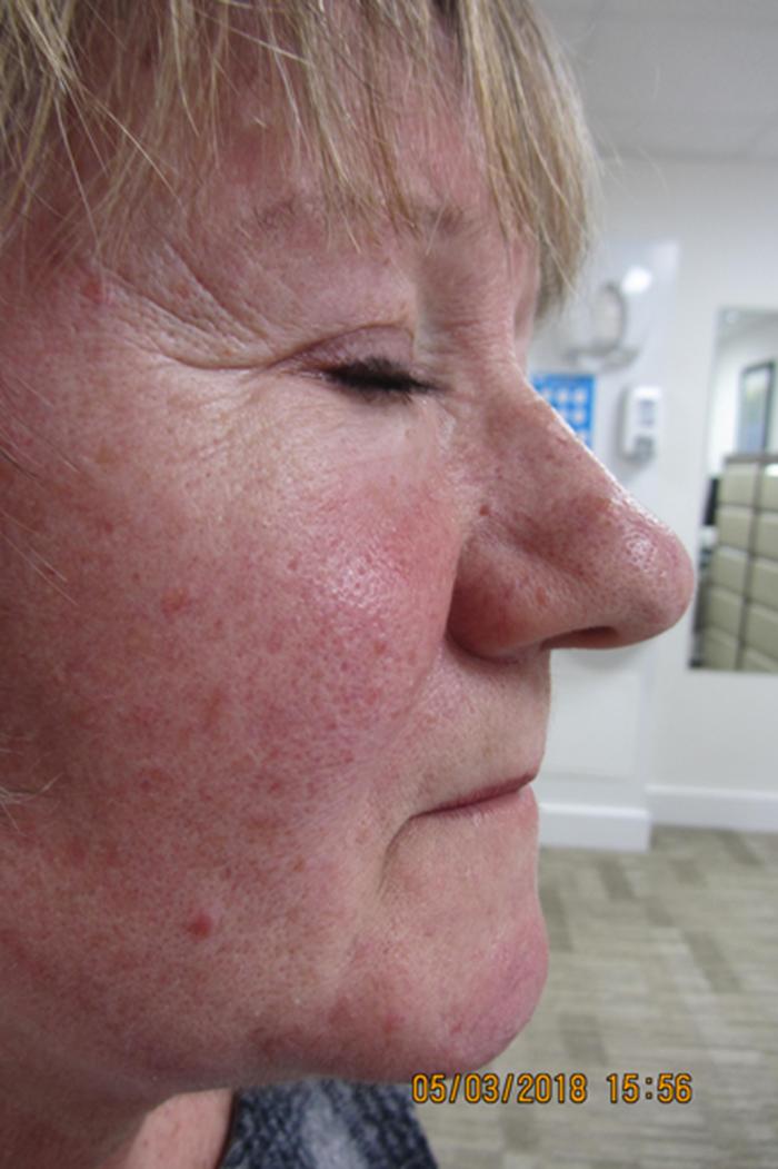 A suggested management pathway for rhinophyma and benign superficial