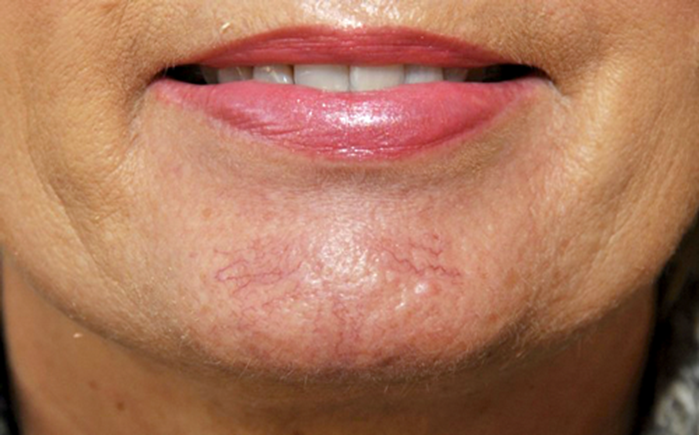 Comentarii despre varicose facial - nipon.ro