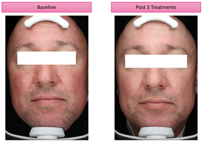 Forum rosacea Return of