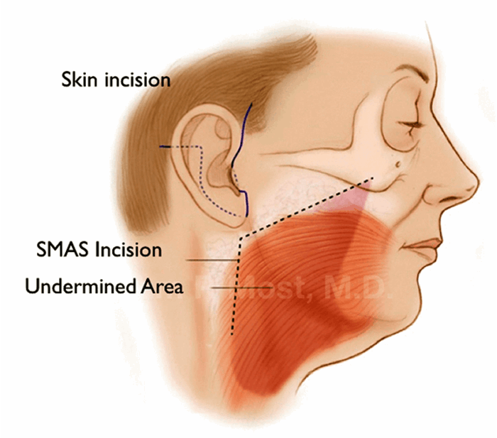 The Truth Behind Facelift Myths The Pmfa Journal