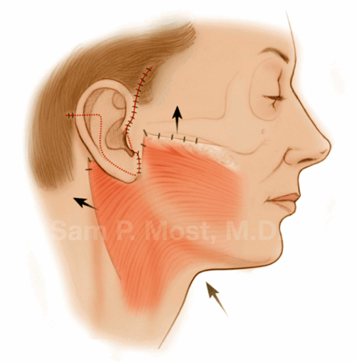 The Art Of A Facelift Part 3 Artiste Plastic Surgery