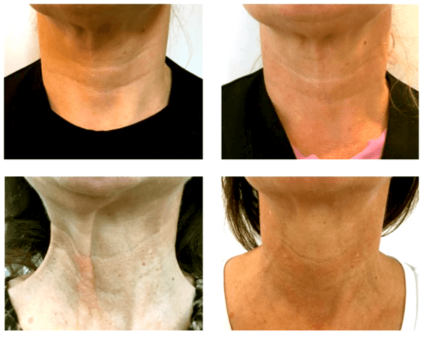 hyaluronic acid on neck