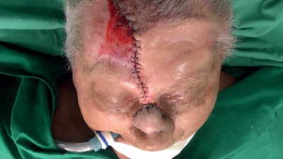 limpiador Una vez más Componer Converse scalping flap for nasal reconstruction procedures | The PMFA  Journal