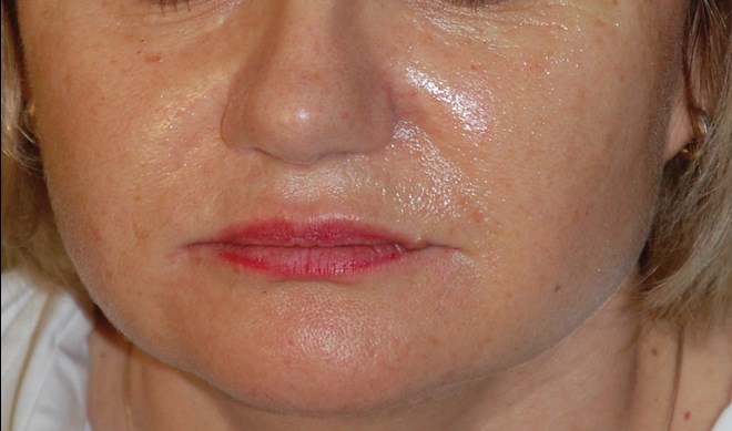 HA dermal filler with lidocaine: initial clinical outcomes | The PMFA