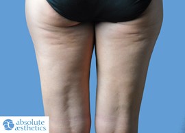 Cellulite: does wearing compression hosiery work?