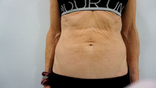 Patient’s abdomen before Profound.