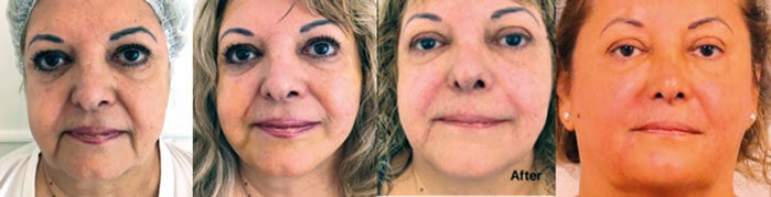 How I Do It Skin Tightening Fotona 4d Protocol The Pmfa Journal