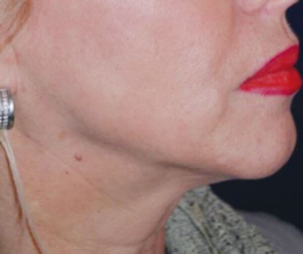 Patient post-treatment.