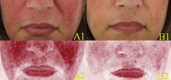 Before and after - clinical and erythema-directed photography 1