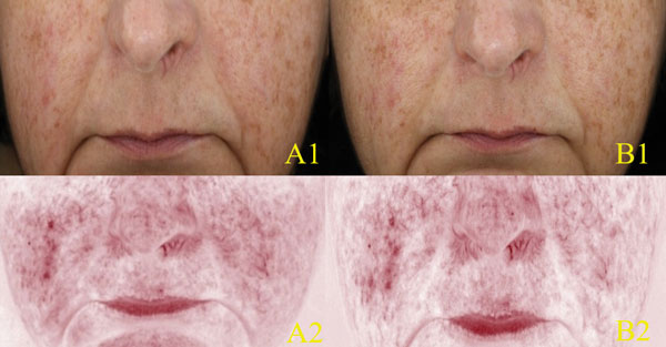 ivermectin rosacea