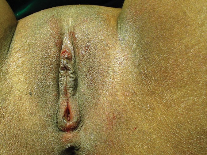 Virgin Hymen Virgin Hymen