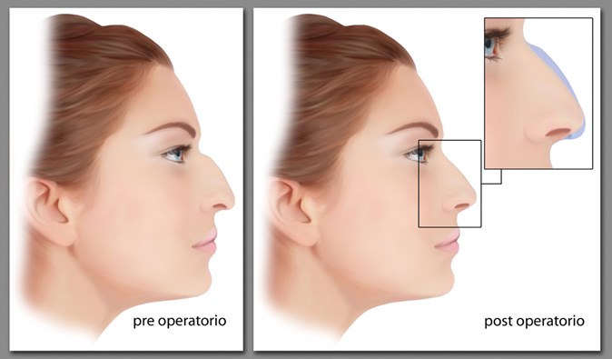 How I Do It Nose Reshaping Using Advanced Fillers The Pmfa Journal
