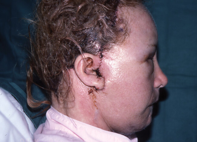 Angioedema of face after facelift; the patient had an allergy to penicillin.