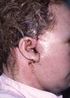 Angioedema of face after facelift; the patient had an allergy to penicillin.