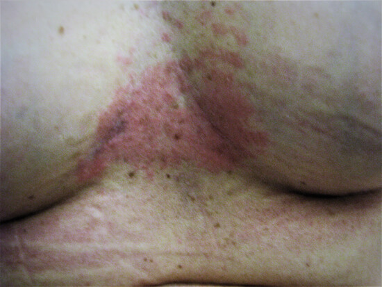 allergy