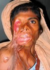 Acid attack