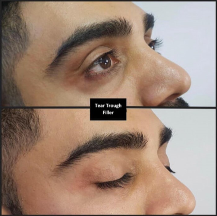 One Point Tear Trough Correction The Pmfa Journal