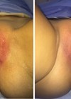 Vulvar tightening photos