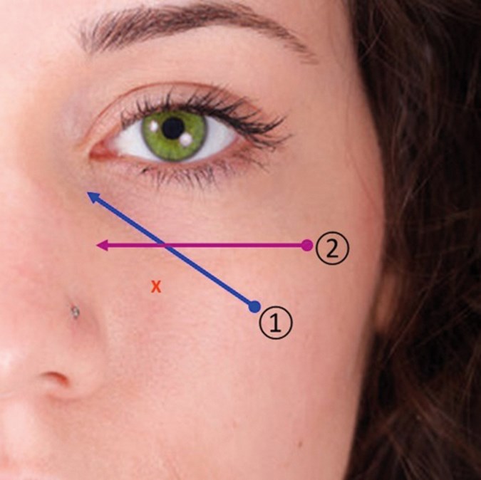 HOW I DO IT Two-Point Eye Lift™: HA dermal fillers for infraorbital