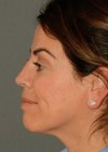 Photo of patient with a saddle nose after treatment with HA filler.