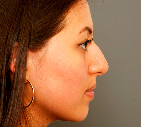 Photo of open approach preservation rhinoplasty 