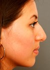 Photo of open approach preservation rhinoplasty 