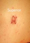 Umbilical stalk shortened and inset to abdominal photo