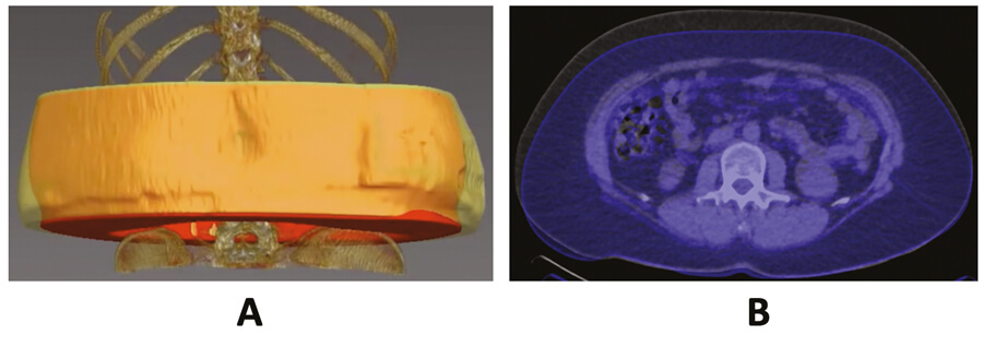 CT images of segmented subcutaneous adipose tissue.