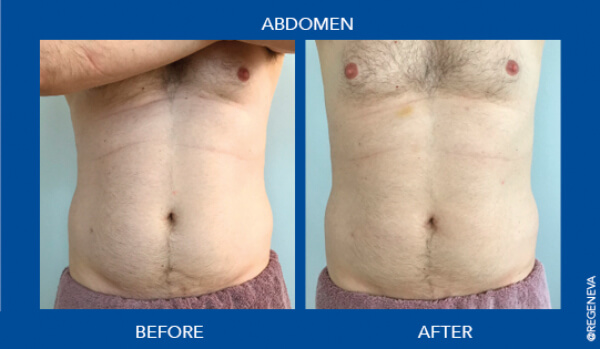 Results of the CRISTAL® programme after one session of cryolipolysis and four sessions of electromagnetic stimulation photos