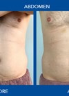 Results of the CRISTAL® programme after one session of cryolipolysis and four sessions of electromagnetic stimulation photos