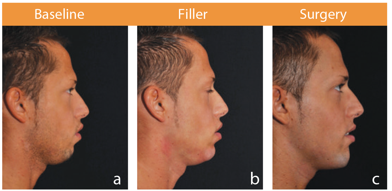 permanent fillers
