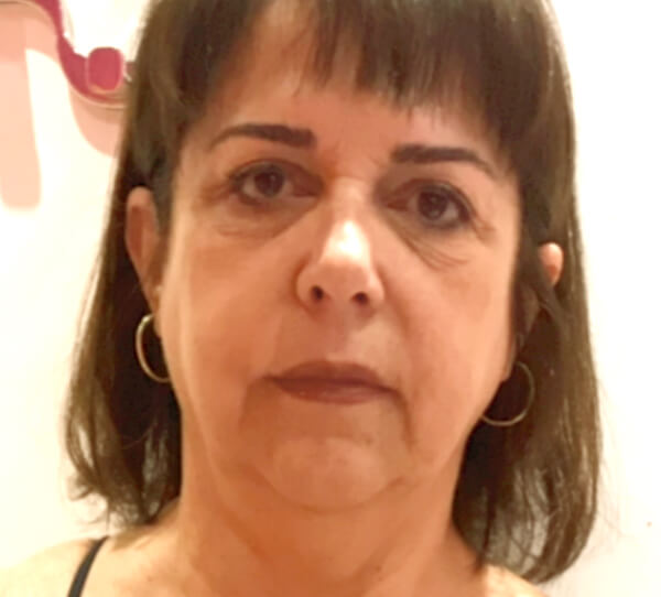 Augmentation article - Patient with deflation after surgery