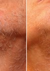 Photo showing after six sessions with six-week intervals.