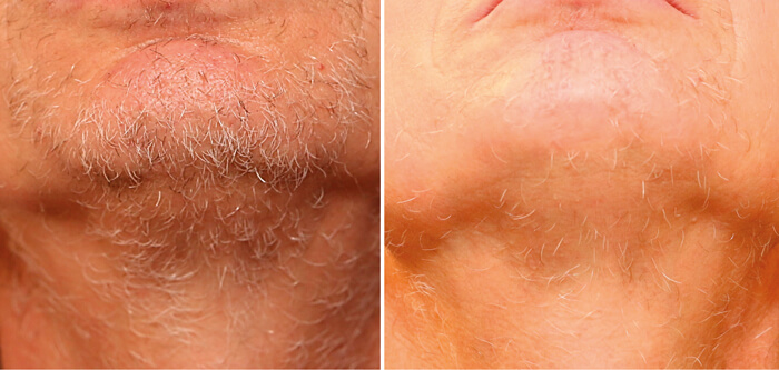 last hair removal