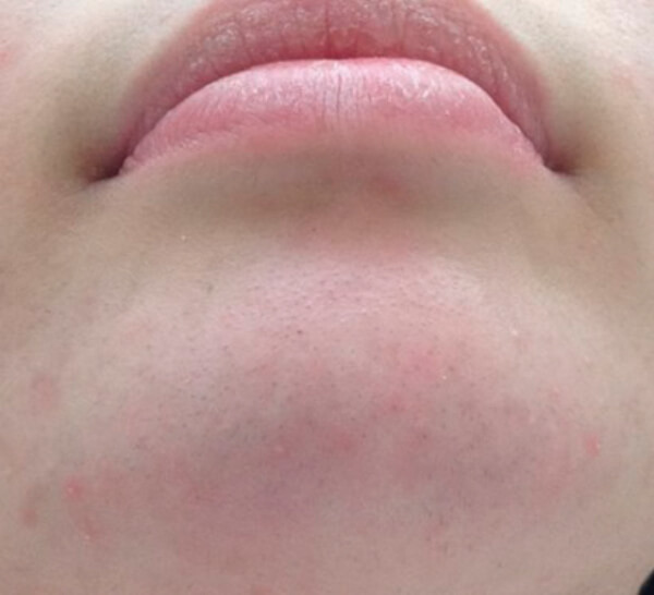 Photo showing after five sessions.