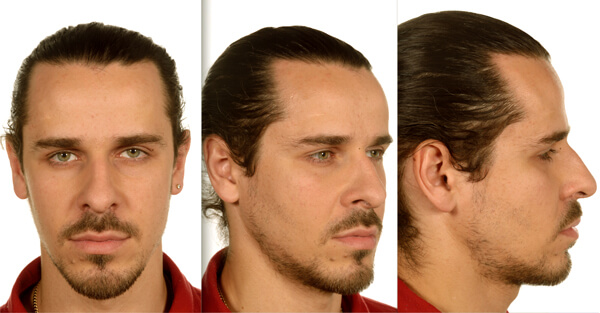 Mid-facial augmentation with malar implants | The PMFA Journal Mid-facial augmentation with malar implants | The PMFA Journal