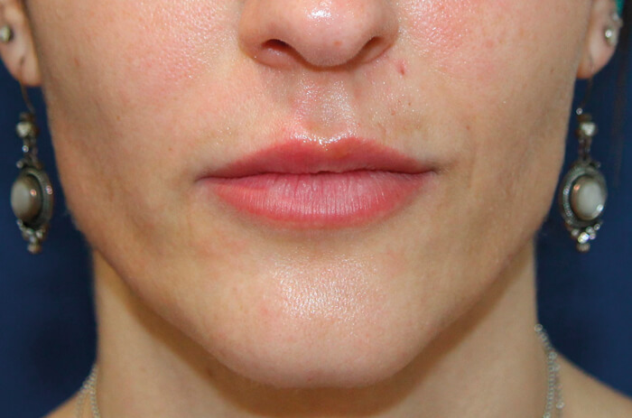 After four sessions photo