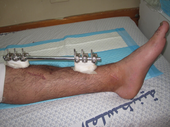 9-year-old male with a Gustilo IIIb middle 1/3rd tibia and fibular fracture, left leg photo.