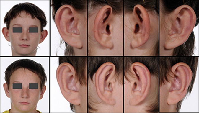 How to clean ears after otoplasty