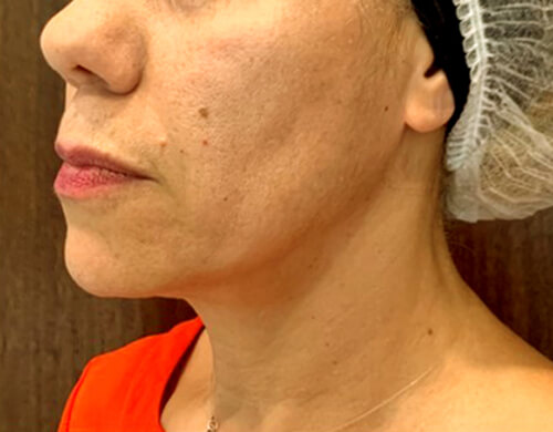 Skin tightening article, after treatment photo