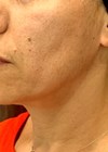 Skin tightening article, after treatment photo